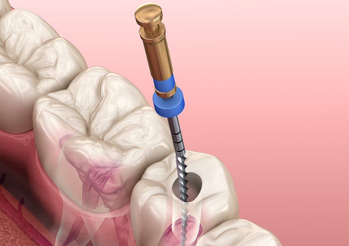 Emergency Root Canals